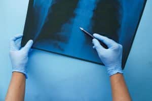Medicii s-au îngrozit când i-au văzut radiografia. Pacientul s-a prezentat la spital cu o tuse persistentă