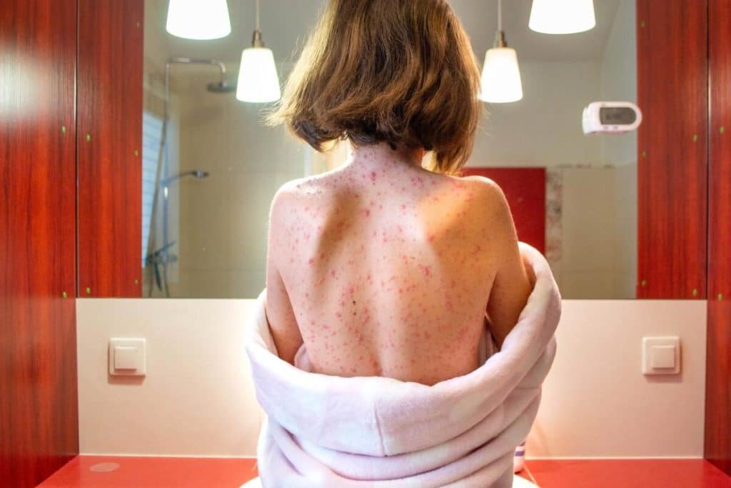 Alertă de rujeolă în Anglia. Ar putea apărea un focar de până la 160.000 de cazuri, în lipsa vaccinării