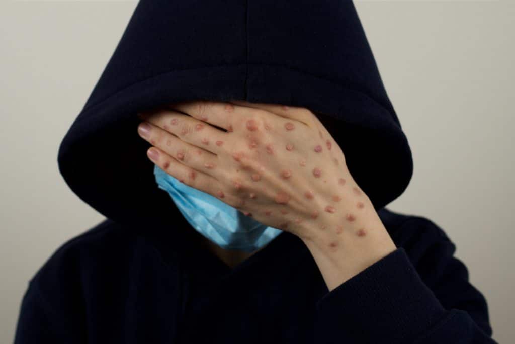 Mpox, declarată de OMS o „urgență de sănătate publică de interes internațional”.  Este timpul să ne facem griji?