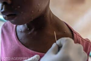Ajung primele vaccinuri împotriva variolei maimuței în Africa. În alte părți ale lumii au fost disponibile de mai multe săptămâni